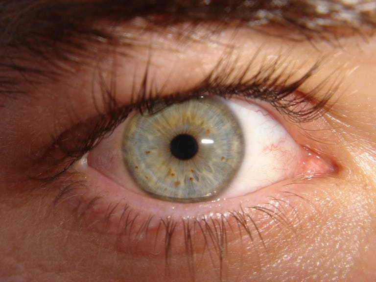 Bipolar Eyes Before and After