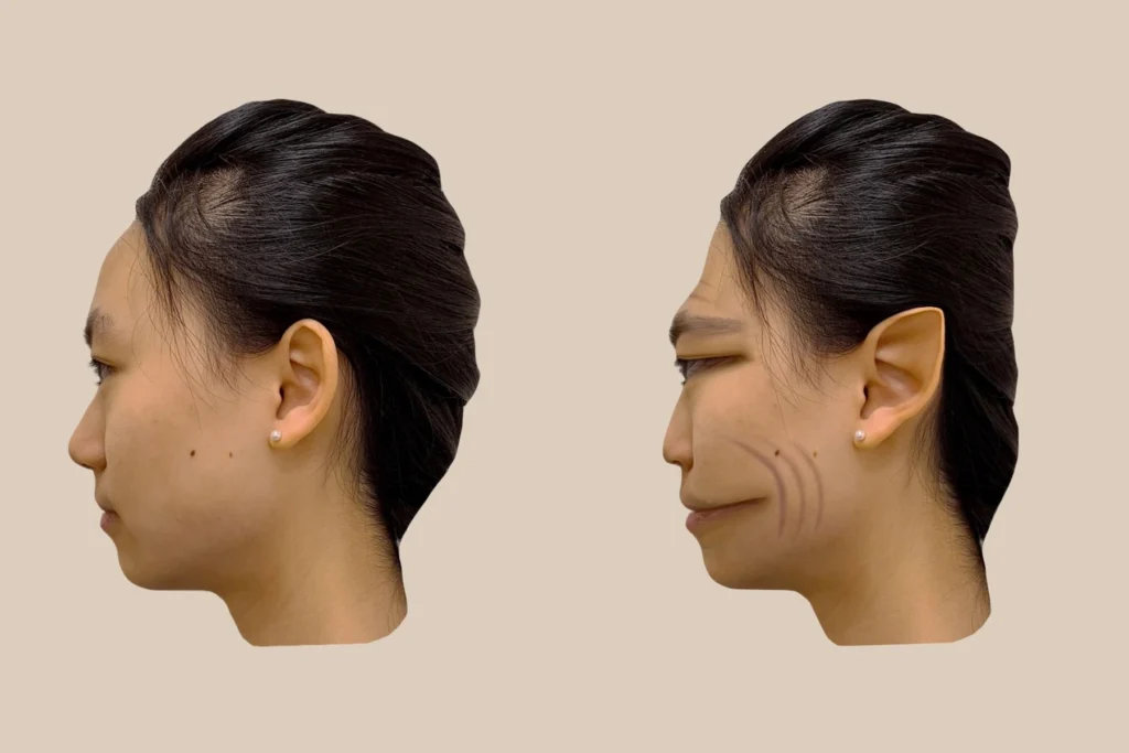 Bipolar Facial Features Female